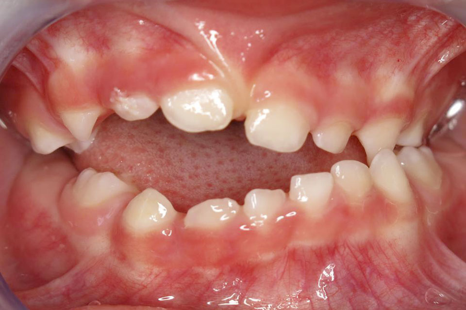Symlptômes : Les dents antérieures ne se touchent pas (béance)