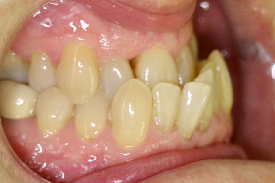 Symptômes : Les dents du bas sont trop en avant