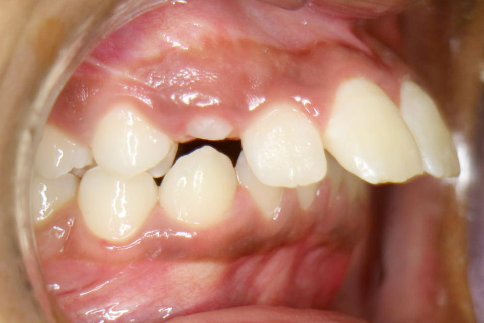 Symptômes : Les dents du haut sont trop en avant