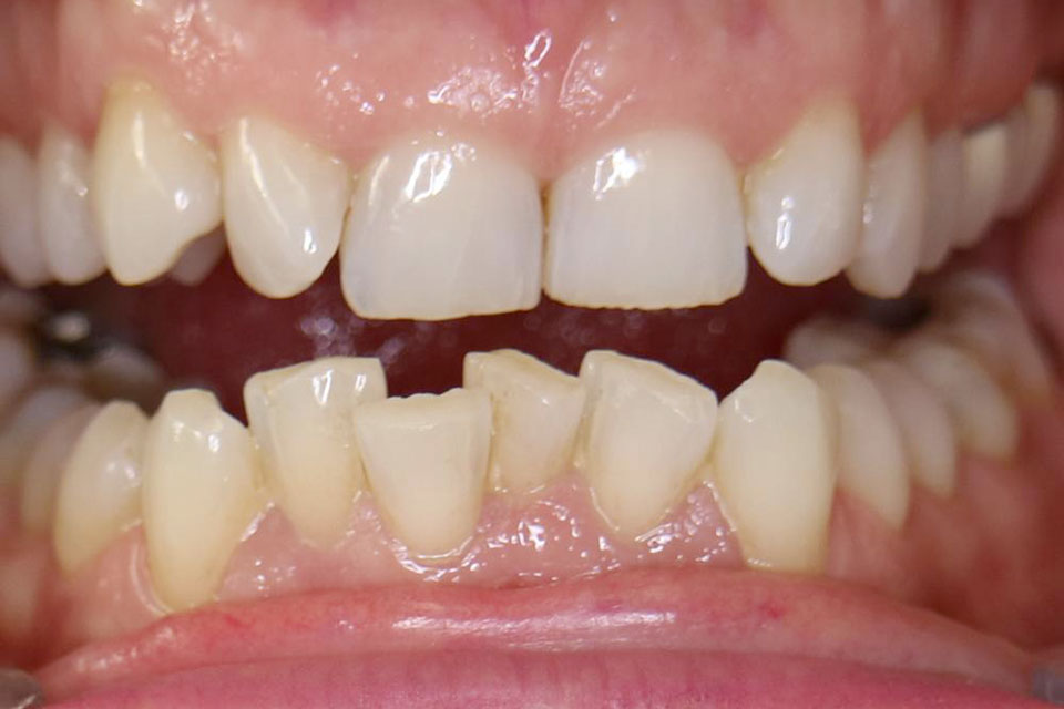 Symptômes : Les dents sont mal alignées
